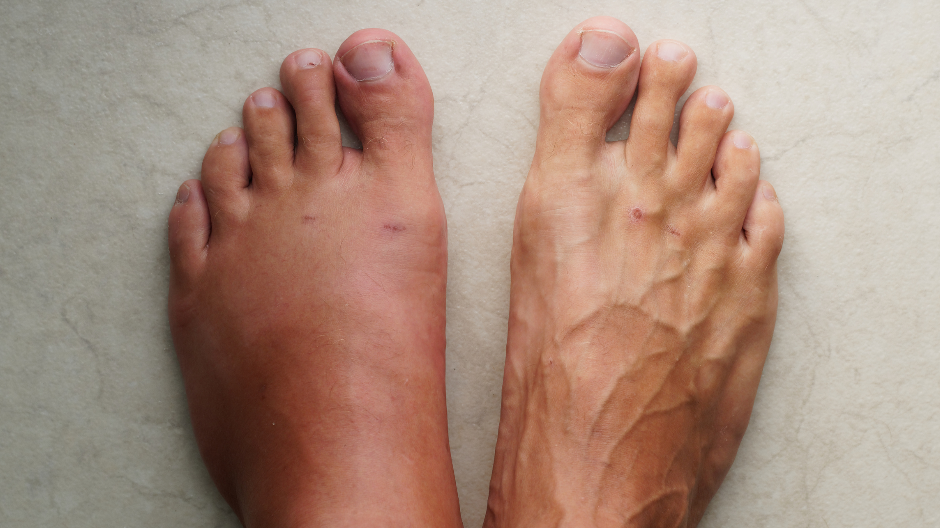 pieds gonflés pieds gonflés
